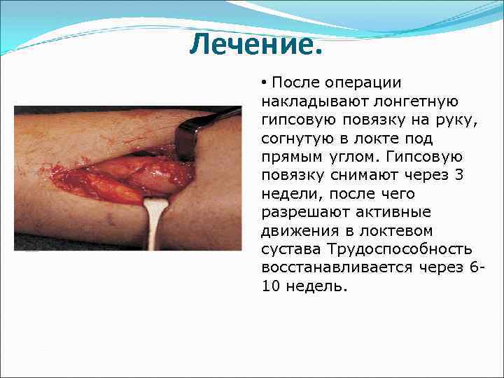 Лечение. • После операции накладывают лонгетную гипсовую повязку на руку, согнутую в локте под