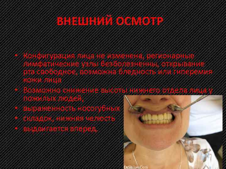 ВНЕШНИЙ ОСМОТР • Конфигурация лица не изменена, регионарные лимфатические узлы безболезненны, открывание рта свободное,