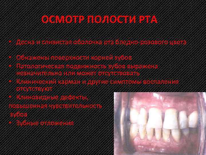 ОСМОТР ПОЛОСТИ РТА • Десна и слизистая оболочка рта бледно розового цвета • Обнажены