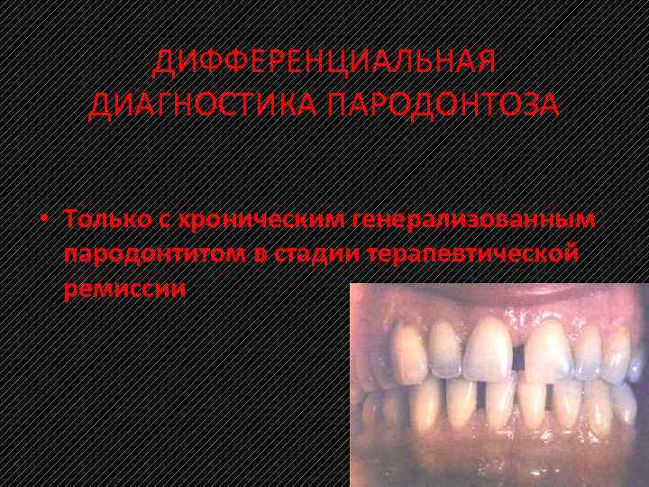 ДИФФЕРЕНЦИАЛЬНАЯ ДИАГНОСТИКА ПАРОДОНТОЗА • Только с хроническим генерализованным пародонтитом в стадии терапевтической ремиссии 