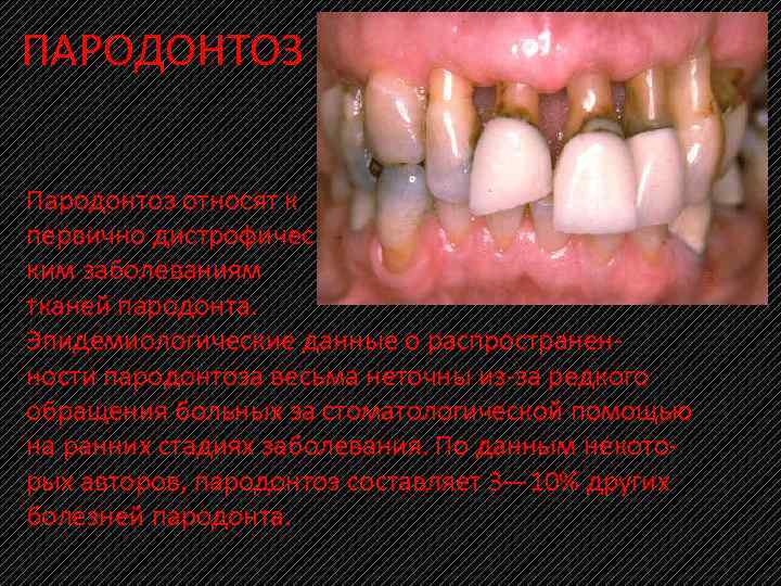 ПАРОДОНТОЗ Пародонтоз относят к первично дистрофичес ким заболеваниям тканей пародонта. Эпидемиологические данные о распространен