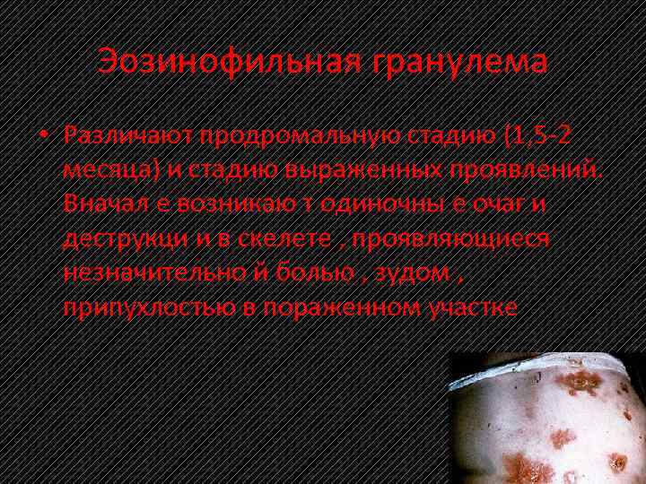 Эозинофильная гранулема • Различают продромальную стадию (1, 5 2 месяца) и стадию выраженных проявлений.