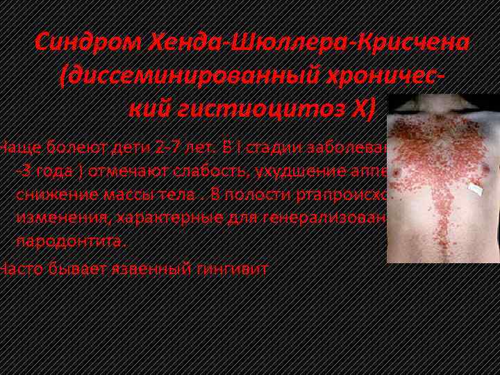 Синдром Хенда-Шюллера-Крисчена (диссеминированный хронический гистиоцитоз X) Чаще болеют дети 2 7 лет. В I