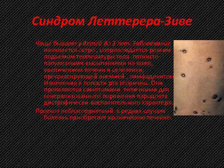 Синдром Леттерера-Зиве Чаще бывает у детей до 3 лет. Заболевание начинается остро , сопровождается
