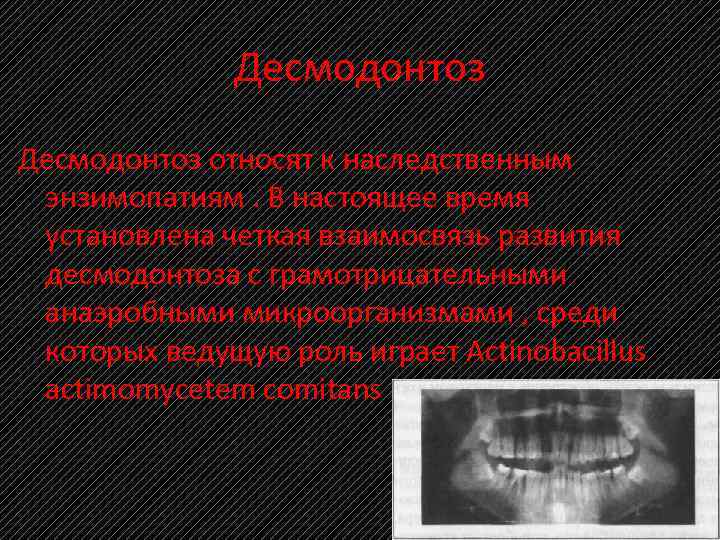 Десмодонтоз относят к наследственным энзимопатиям. В настоящее время установлена четкая взаимосвязь развития десмодонтоза с