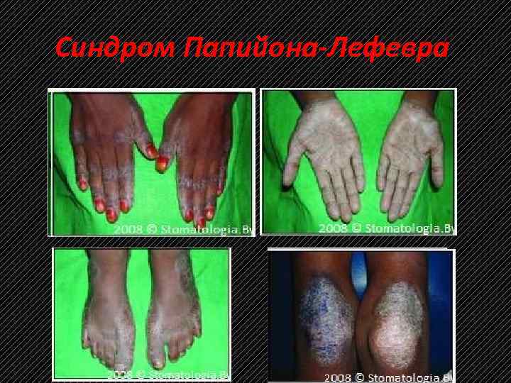 Синдром Папийона-Лефевра 