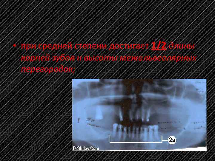  • при средней степени достигает 1/2 длины корней зубов и высоты межальвеолярных перегородок;