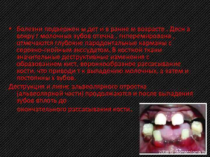  • Болезни подвержен ы дет и в ранне м возрасте. Десн а вокру
