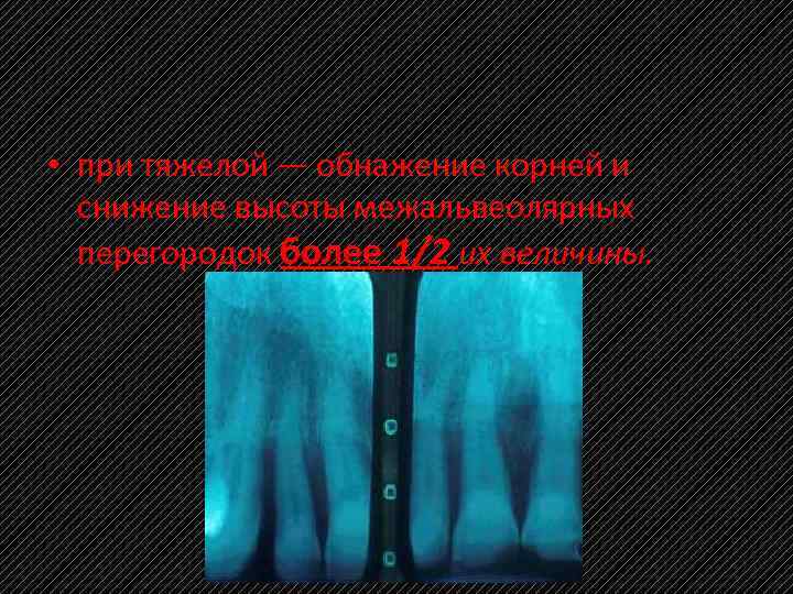  • при тяжелой — обнажение корней и снижение высоты межальвеолярных перегородок более 1/2