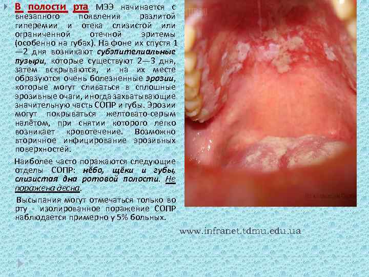  В полости рта МЭЭ начинается с внезапного появления разлитой гиперемии и отека слизистой