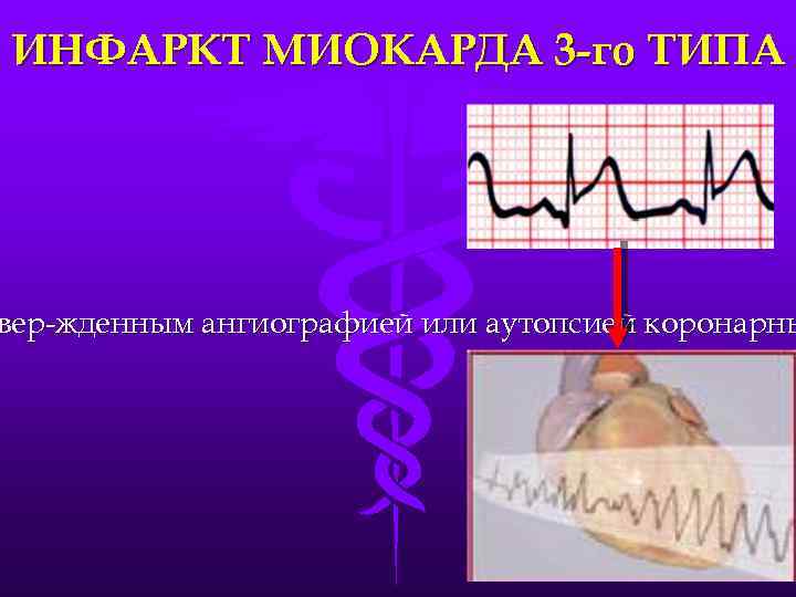 ИНФАРКТ МИОКАРДА 3 -го ТИПА вер-жденным ангиографией или аутопсией коронарны 