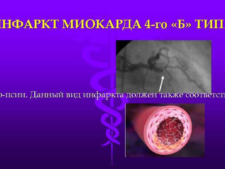 ИНФАРКТ МИОКАРДА 4 -го «Б» ТИПА о-псии. Данный вид инфаркта должен также соответств 