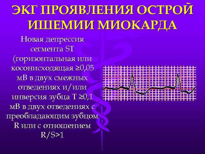 ЭКГ ПРОЯВЛЕНИЯ ОСТРОЙ ИШЕМИИ МИОКАРДА Новая депрессия сегмента ST (горизонтальная или косонисходящая ≥ 0,