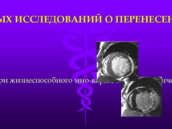 ЫХ ИССЛЕДОВАНИЙ О ПЕРЕНЕСЕН ри жизнеспособного мио-карда, который утонче 