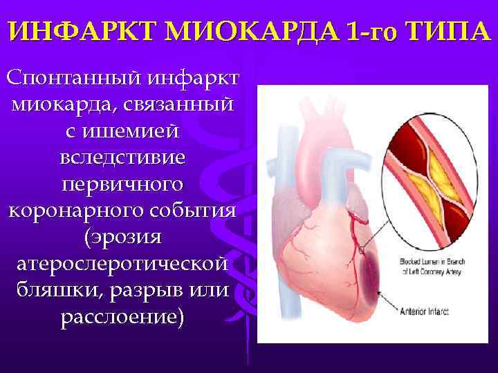 Виды инфаркта. III Тип острого инфаркта миокарда. 5 Типов инфаркта миокарда.