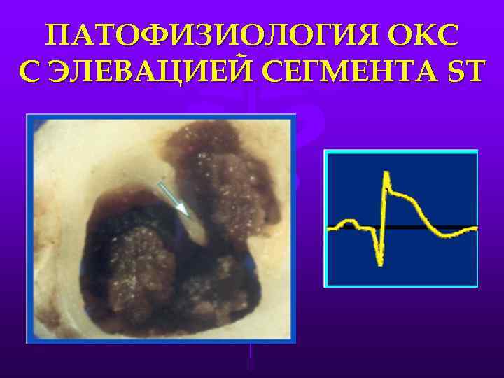 ПАТОФИЗИОЛОГИЯ ОКС С ЭЛЕВАЦИЕЙ СЕГМЕНТА ST 