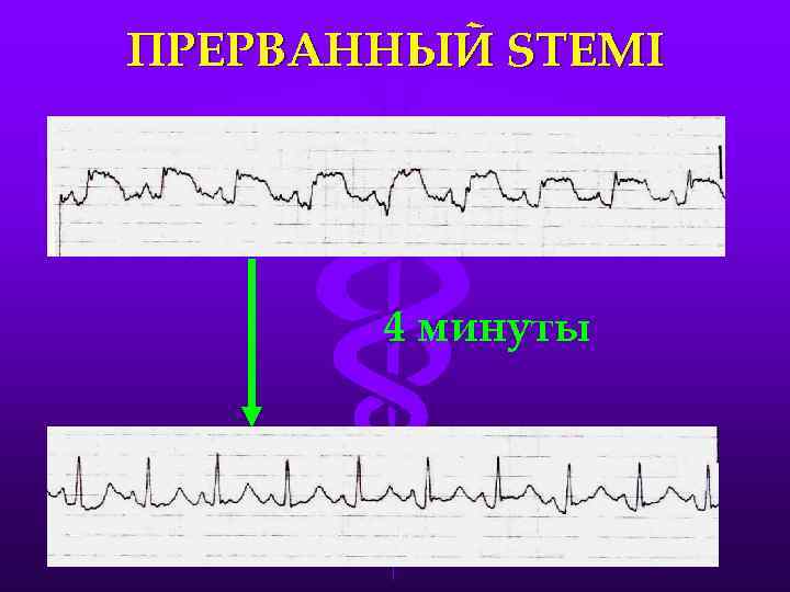 ПРЕРВАННЫЙ STEMI 4 минуты 