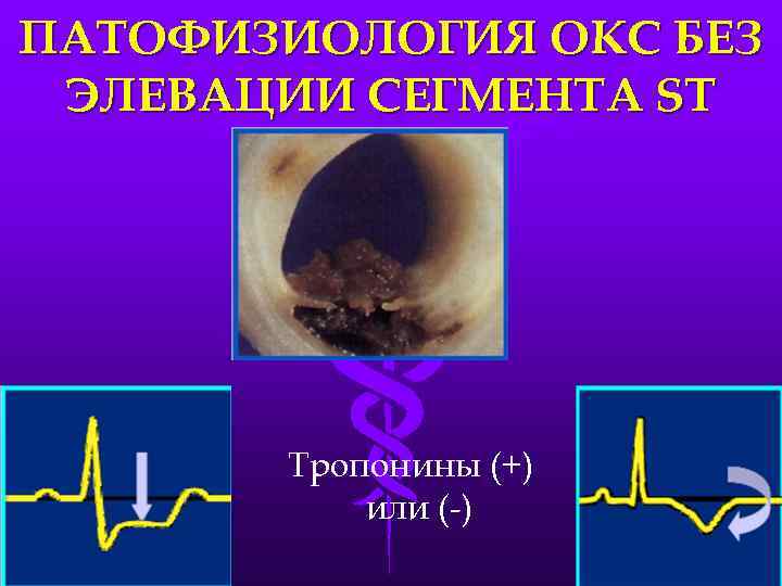ПАТОФИЗИОЛОГИЯ ОКС БЕЗ ЭЛЕВАЦИИ СЕГМЕНТА ST Тропонины (+) или (-) 