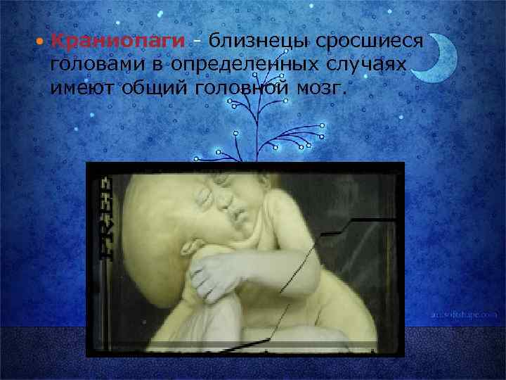  Краниопаги - близнецы сросшиеся головами в определенных случаях имеют общий головной мозг. 