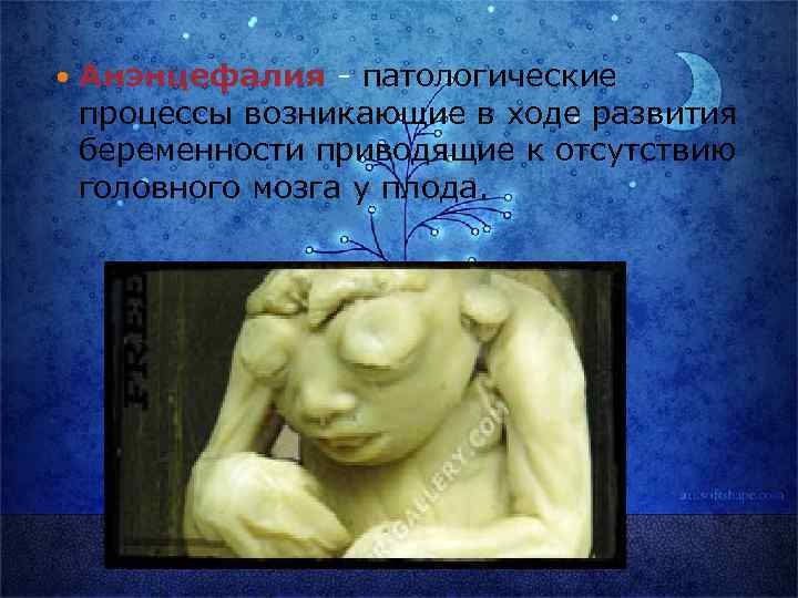  Анэнцефалия - патологические процессы возникающие в ходе развития беременности приводящие к отсутствию головного