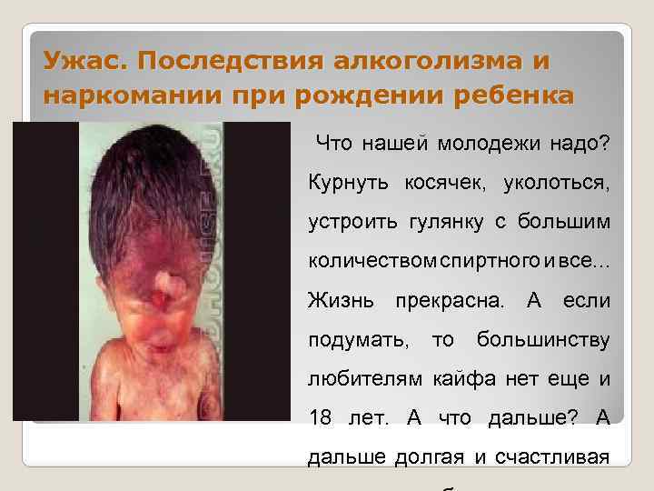 Ужас. Последствия алкоголизма и наркомании при рождении ребенка Что нашей молодежи надо? Курнуть косячек,