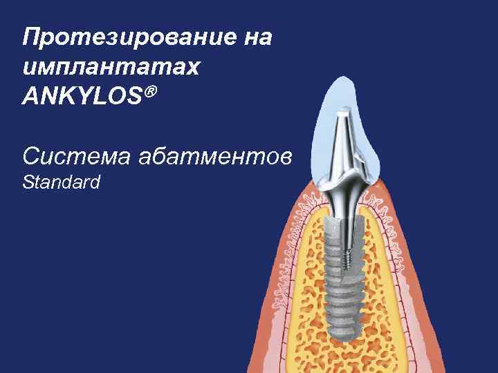 Презентация протезирование на имплантах