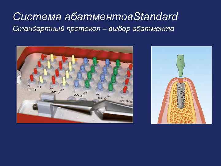 Система абатментов. Standard Стандартный протокол – выбор абатмента 