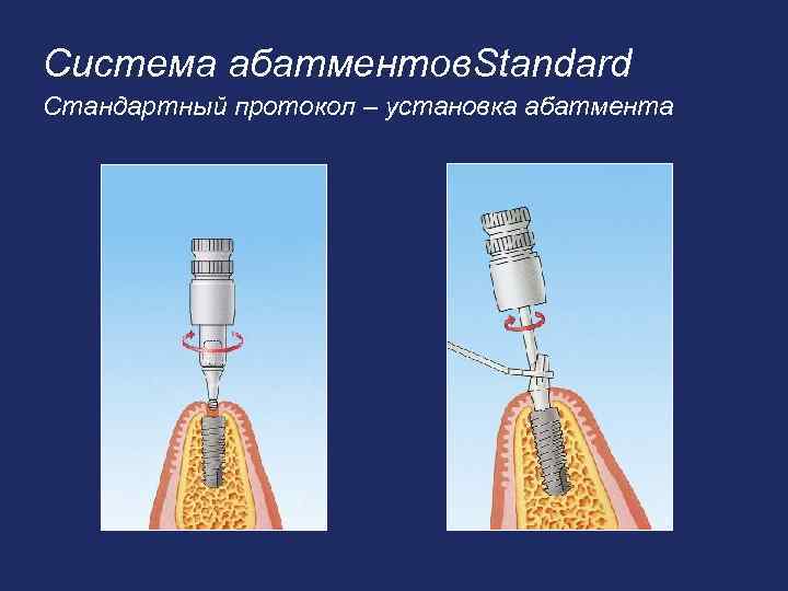 Система абатментов. Standard Стандартный протокол – установка абатмента 