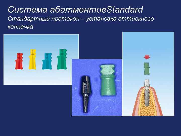 Система абатментов. Standard Стандартный протокол – установка оттискного колпачка 