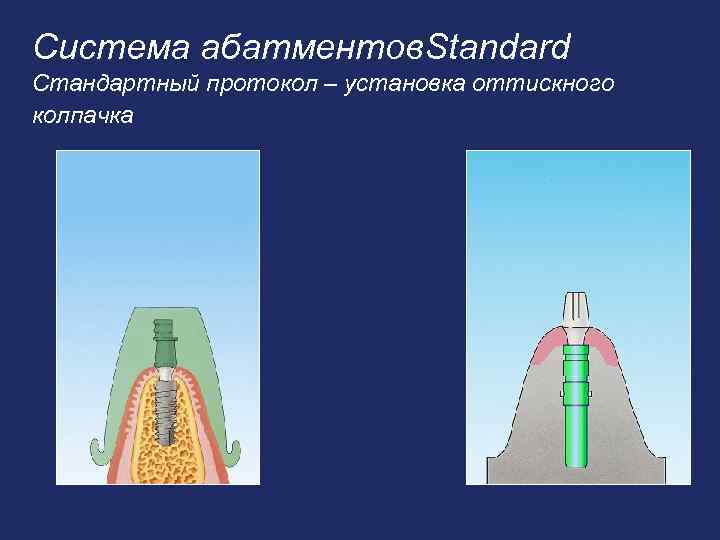 Система абатментов. Standard Стандартный протокол – установка оттискного колпачка 