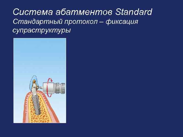 Система абатментов Standard Стандартный протокол – фиксация супраструктуры 