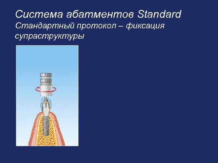 Система абатментов Standard Стандартный протокол – фиксация супраструктуры 