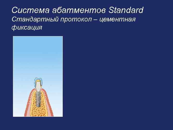 Система абатментов Standard Стандартный протокол – цементная фиксация 