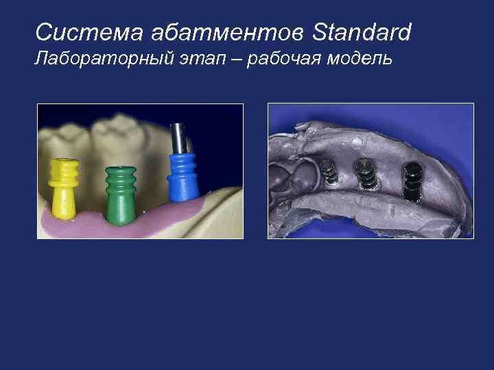 Система абатментов Standard Лабораторный этап – рабочая модель 