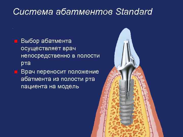 Система абатментов Standard. Выбор абатмента осуществляет врач непосредственно в полости рта n Врач переносит