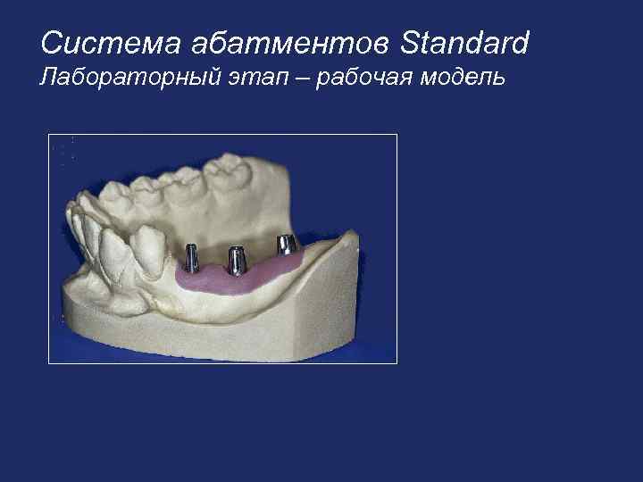 Система абатментов Standard Лабораторный этап – рабочая модель 