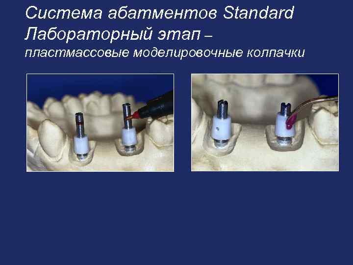 Система абатментов Standard Лабораторный этап – пластмассовые моделировочные колпачки 