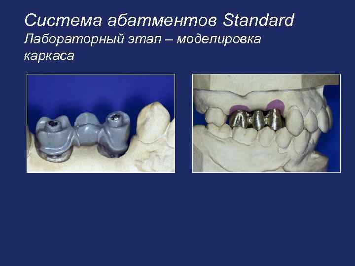 Система абатментов Standard Лабораторный этап – моделировка каркаса 