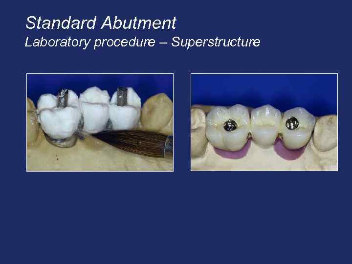 Standard Abutment Laboratory procedure – Superstructure 