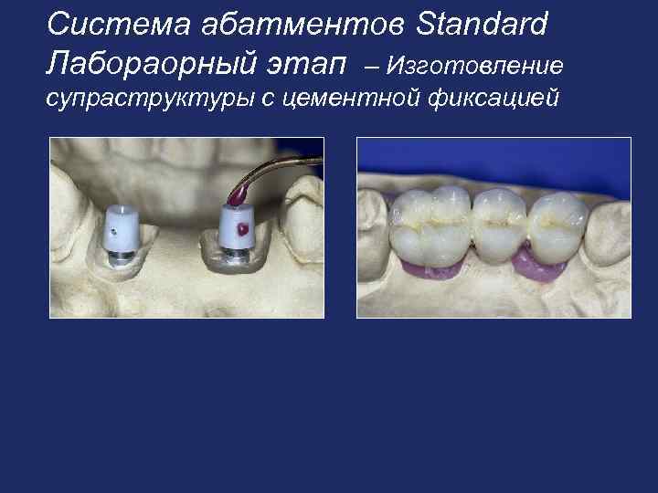 Система абатментов Standard Лабораорный этап – Изготовление супраструктуры с цементной фиксацией 