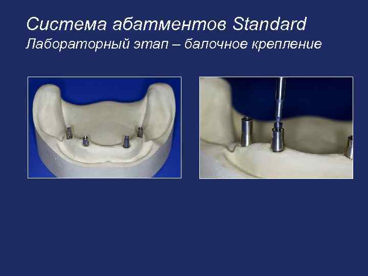 Система абатментов Standard Лабораторный этап – балочное крепление 