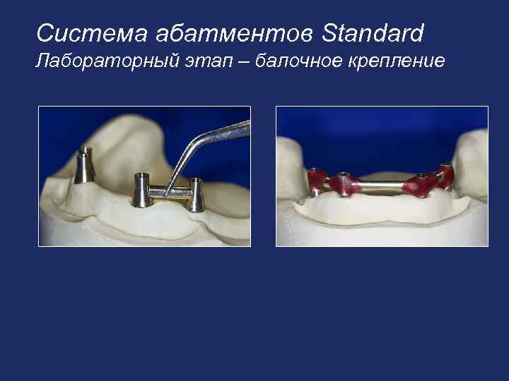 Система абатментов Standard Лабораторный этап – балочное крепление 