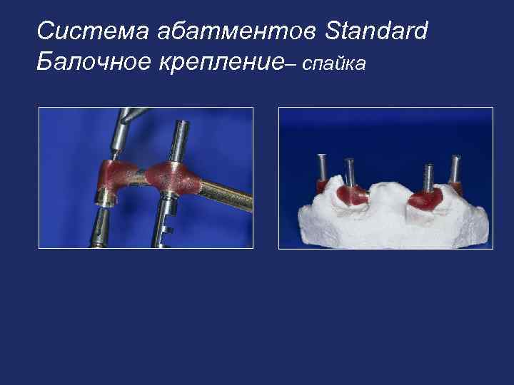 Система абатментов Standard Балочное крепление– спайка 