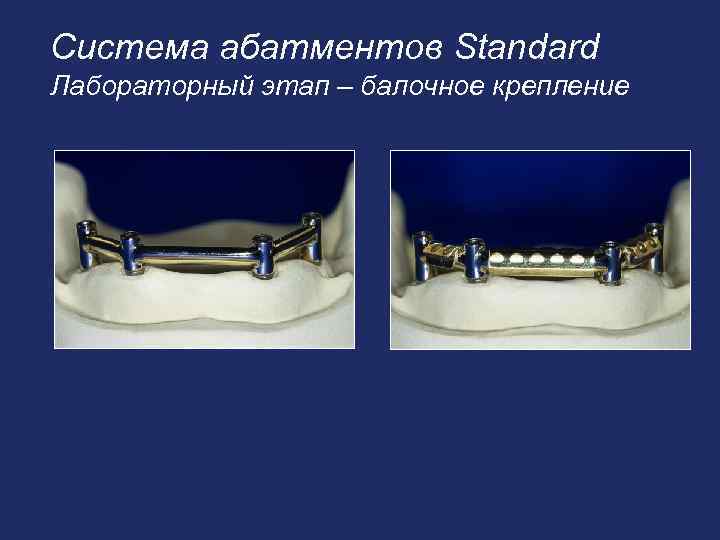 Система абатментов Standard Лабораторный этап – балочное крепление 