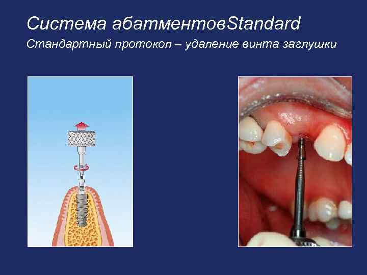 Система абатментов. Standard Стандартный протокол – удаление винта заглушки 