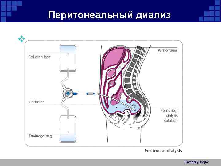 Перитонеальный диализ схема