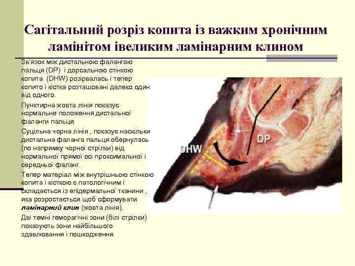 Сагітальний розріз копита із важким хронічним ламінітом івеликим ламінарним клином Зв‘язок між дистальною фалангою