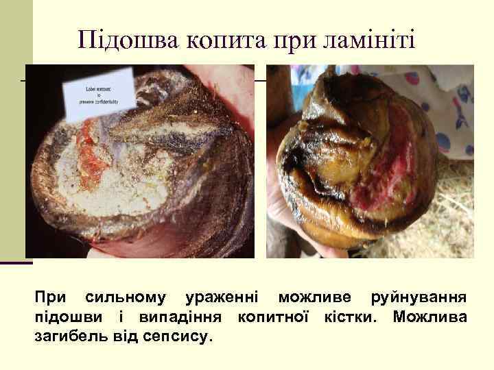 Підошва копита при ламініті При сильному ураженні можливе руйнування підошви і випадіння копитної кістки.