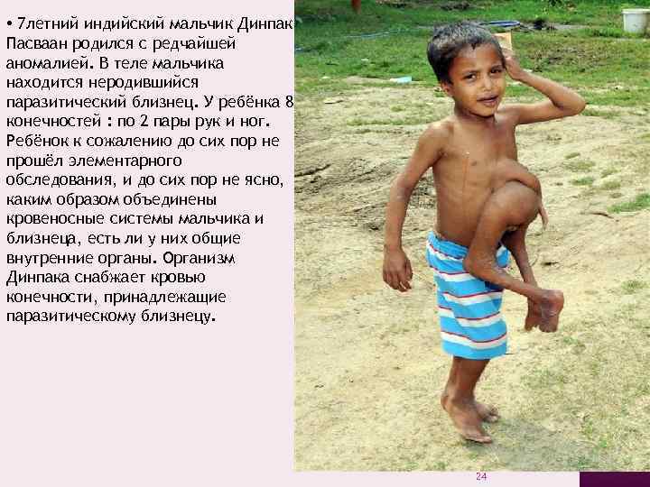  • 7 летний индийский мальчик Динпак Пасваан родился с редчайшей аномалией. В теле