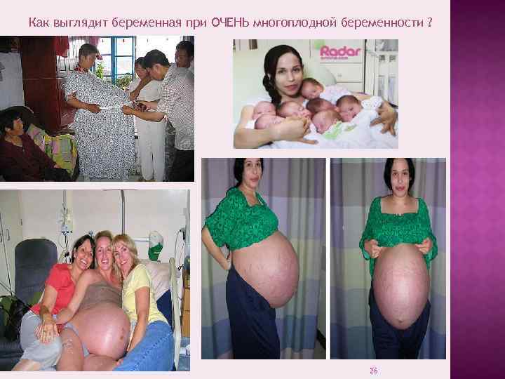 Как выглядит беременная при ОЧЕНЬ многоплодной беременности ? 26 